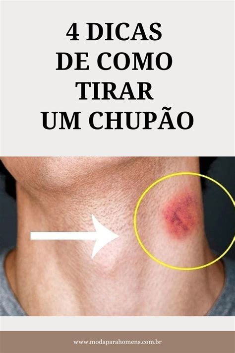 como tirsr chupao|Como Se Livrar de Um Chupão Da Noite pro Dia: 9 Passos